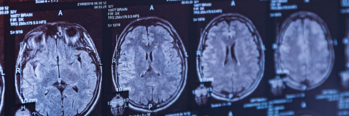 A demencia és a stroke közös tőről fakad?