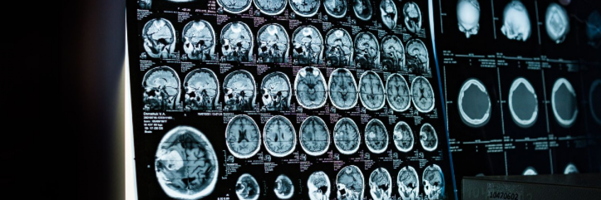 Mit jelent a minor stroke (TIA) és miért kell kivizsgálni?
