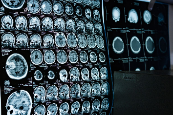 Mit jelent a minor stroke (TIA) és miért kell kivizsgálni?
