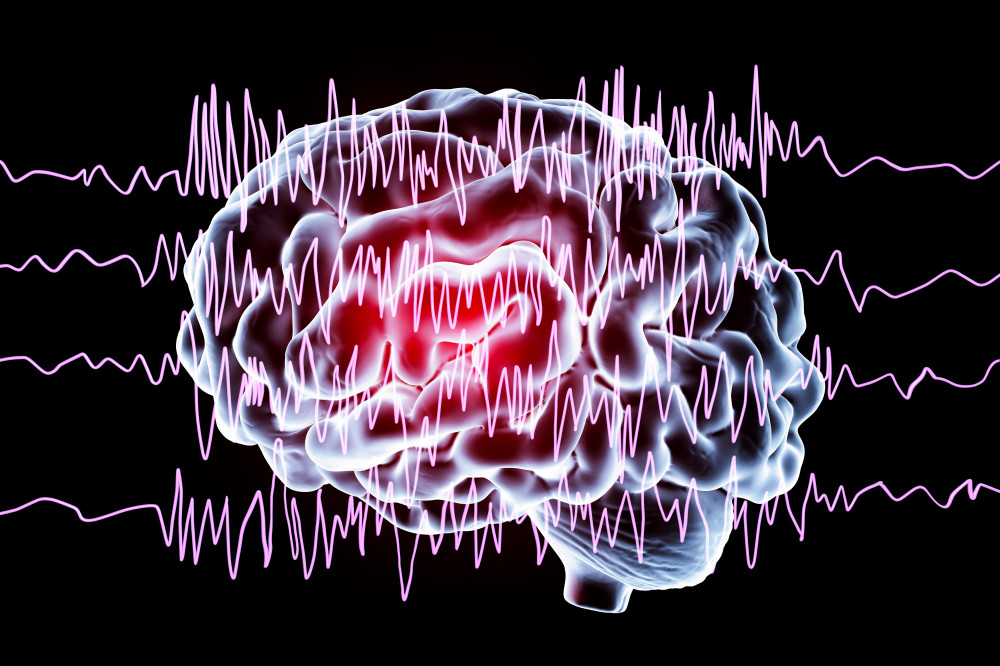 Mi okozza az epilepsziás rohamokat?